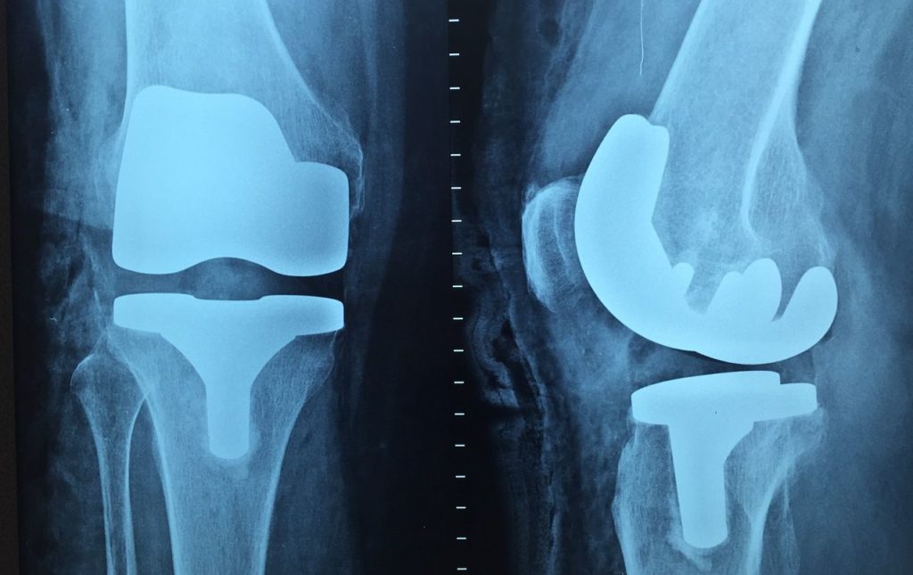 膝の痛み4種類とストレッチ